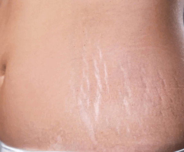 What are Some Effective Ways to Reduce or Prevent Stretch Marks
