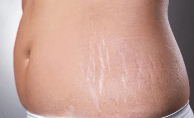 What are Some Effective Ways to Reduce or Prevent Stretch Marks